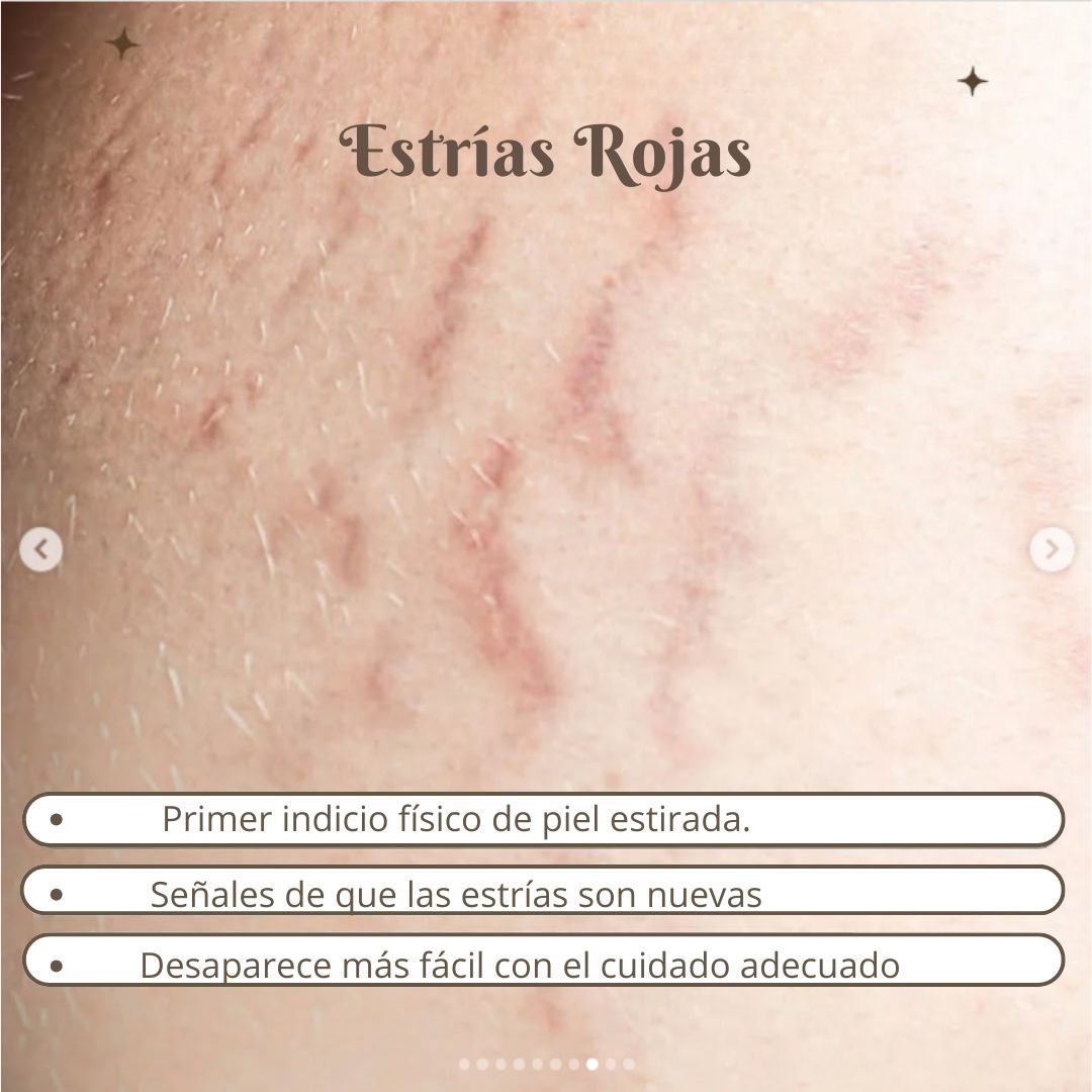 CIARA: Dile adiós a las estrías